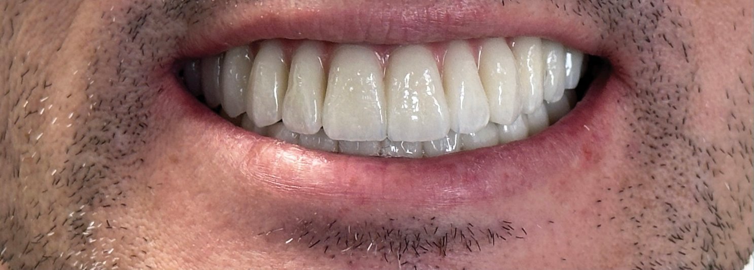 Angelo tras la rehabilitación oral completa