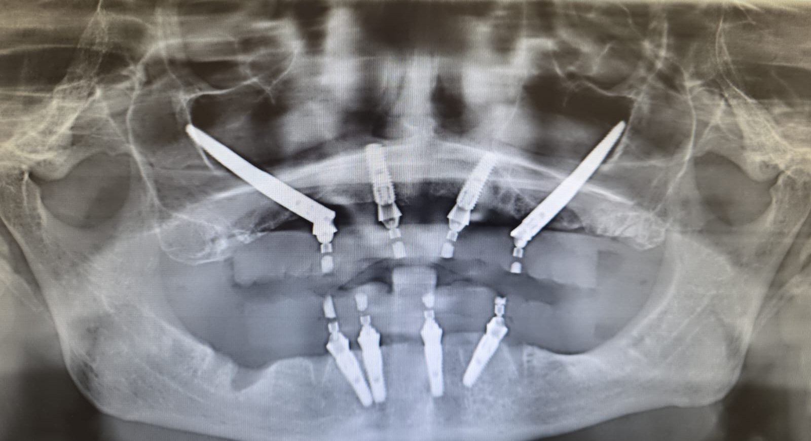 Silvana tras la rehabilitación con implantes cigomáticos