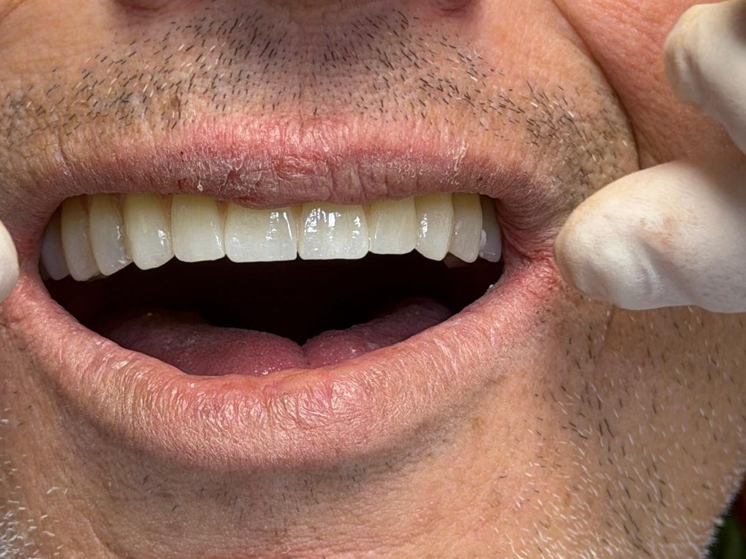 La sonrisa tras la rehabilitación con implantes cigomáticos