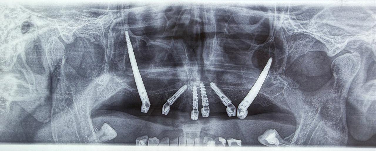 Radiografía con los implantes cigomáticos