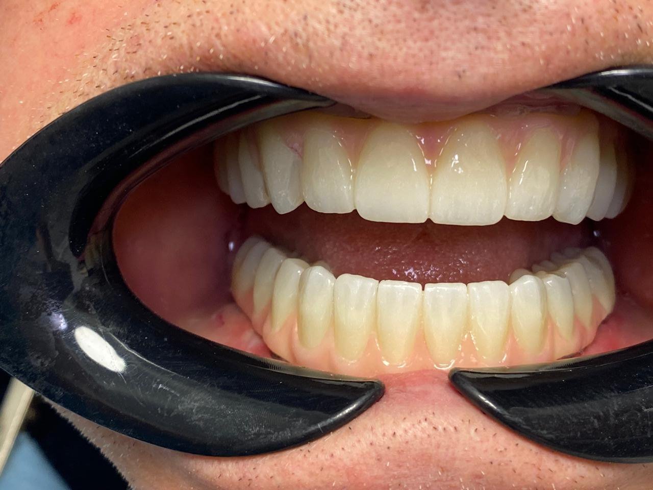 La sonrisa tras la rehabilitación completa con implantes cigomáticos