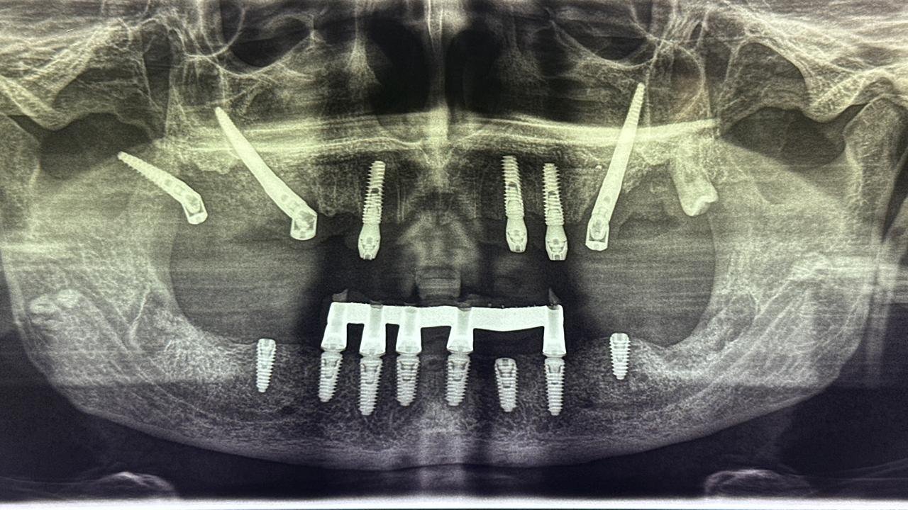 Radiografía tras la rehabilitación con implantes cigomáticos